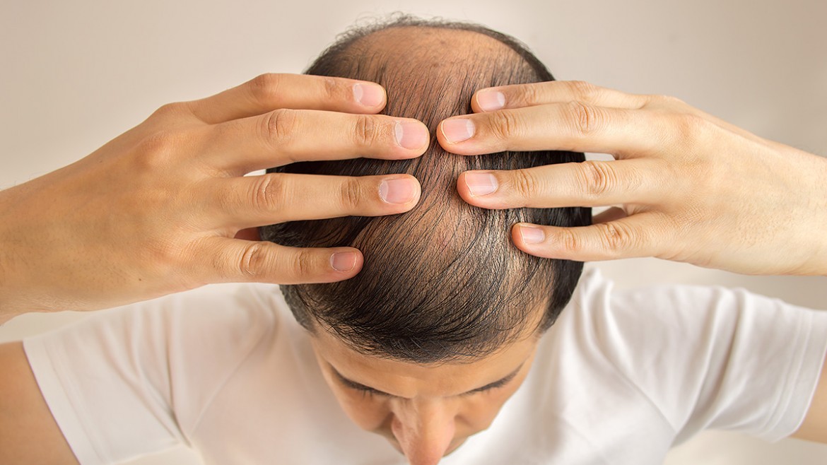 Human Growth Hormone (HGH) For Prevent Hair Loss And Regrowth