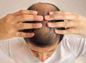 Male androgenetic alopecia