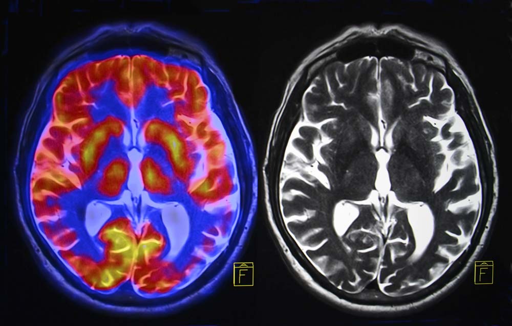 testosterone brain activity