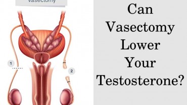 Can Vasectomy Lower Your Testosterone?