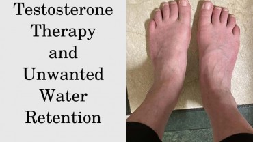 Testosterone therapy and unwanted water retention
