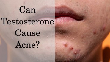 Can testosterone cause acne?