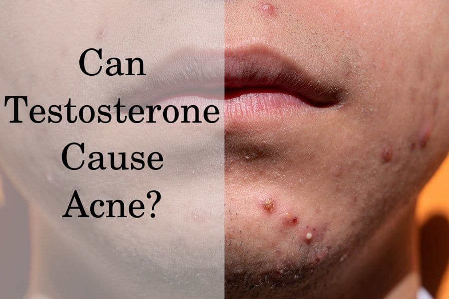 Is Testosterone A Cause Of Your Acne HRTGuru