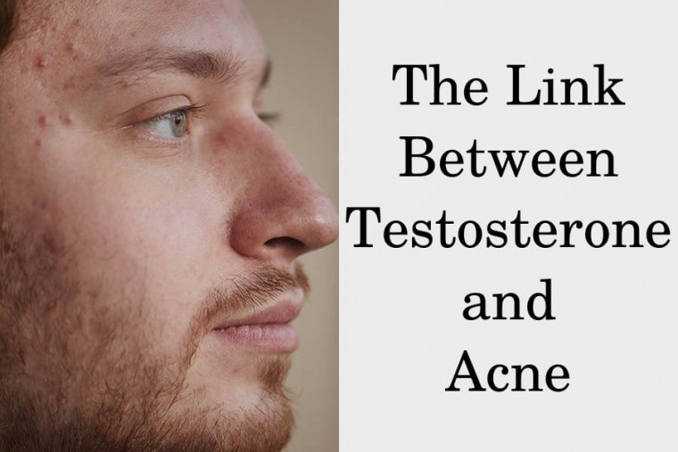 Is Testosterone a Cause of Your Acne? HRTGuru