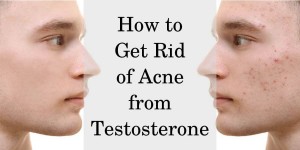 How to get rid of acne from testosterone